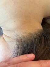 エステアンドヘアーサロン アルテ 札幌/白髪になる前にうなじ脱毛