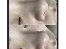 ハイドロスプラッシュで黒ずみサヨナラ！！つるんつるん肌に♪