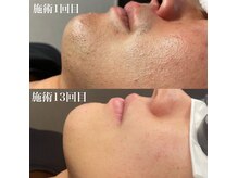 ポロポロ抜ける！ヒゲ脱毛リピート率97％！