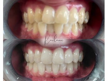 カイラニ サロン(Kai lanl salon)/ホワイトニング
