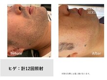 レア(Le'a)/【ヒゲ脱毛】