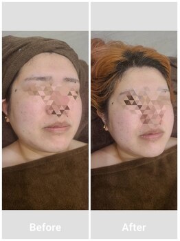 ミル(milu)/肌トラブル改善★毛穴洗浄！