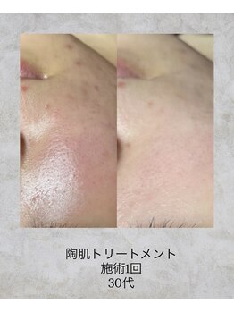 コンクパール(CONCH PEARL.)/陶肌トリートメント