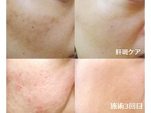 ナチュレアンドメディカ(Nature&Medica)/肌荒れ or カンパンケア