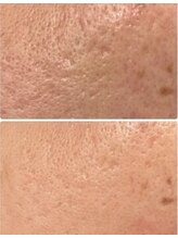 BUB 立川/肌の凸凹でお悩みの方