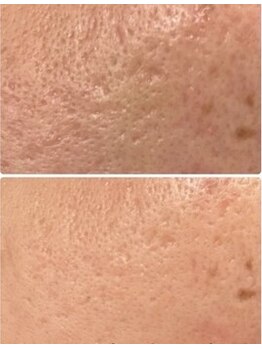 BUB 立川/肌の凸凹でお悩みの方