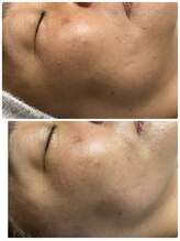 ソルツーサロン マナ(MANA)/３D超音波リフト