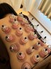 カッピング(吸い玉)+鍼灸施術50分　【デトックス/疲労回復】