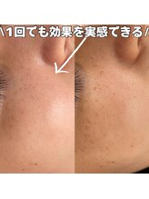 ベルファーム(Belle Femme)/気になるそのシミケアに！！