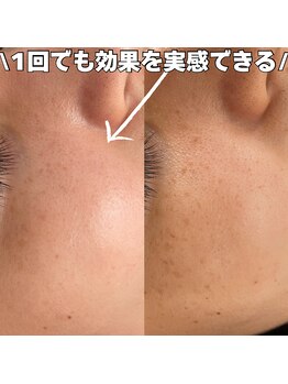 ベルファーム(Belle Femme)/気になるそのシミケアに!!