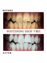 ホワイトニングショップ 千葉店/長年の着色汚れもスッキリ♪