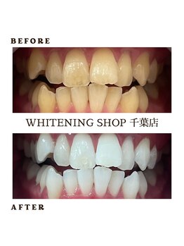 ホワイトニングショップ 千葉店/長年の着色汚れもスッキリ♪