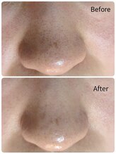 ラヴィアンローズ 蒲郡店(& La vie en Rose)/毛穴ケア