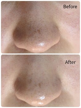 ラヴィアンローズ 蒲郡店(& La vie en Rose)/毛穴ケア