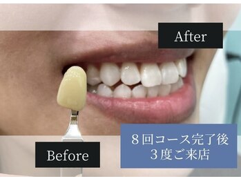 ホワイトニングカフェ 白山店(WhiteningCafe)/◎歯のホワイトニング施術写真◎