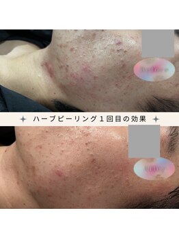 ディアー(Dear)/REVI 陶肌トリートメント