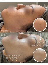 シツ(SHITSU)/【症例】ハーブピーリング・初回