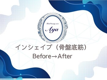 トータルビューティケア アヤ(Aya)/インシェイプ/Before After