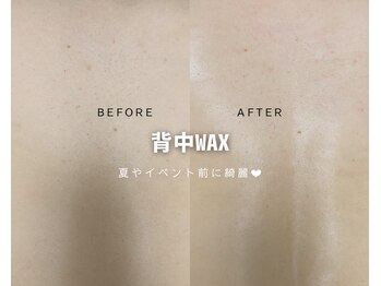 ルナソルビューティーサロン 浜松店(Lunasol)/背中 MIX脱毛♪