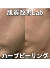 肌質改善Lab｜韓国美容/毛穴/ハーブピーリング/ニキビケア｜/水光ピーリング｜ニキビケア