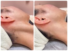 エクボ(EcBeau)/うなじ脱毛といえばエクボ!