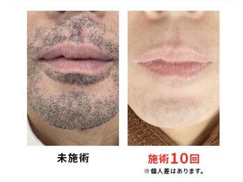 レピア(LEPIA)/メンズヒゲ脱毛