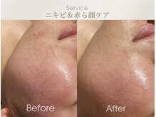 フェイシャルサロン ベルダ(BELDA)/【赤ら顔＆ニキビケア】