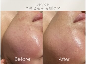 フェイシャルサロン ベルダ(BELDA)/【赤ら顔&ニキビケア】