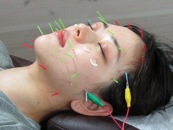 リフォルメ(REFORME)の写真/【小顔＋美容鍼】美容鍼灸師によるオーダーメイド施術☆リフトアップ×エイジングケアにおすすめ◎