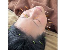 まこと鍼灸院の雰囲気（50代目前！気になるシミ・しわ・たるみを美容鍼で今からケア◎）