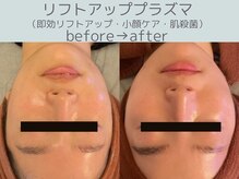 シエスタ(siesta)/リフトアッププラズマ・小顔ケア