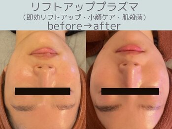 シエスタ(siesta)/リフトアッププラズマ・小顔ケア