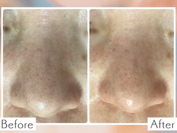 ディオーネ 上越南高田店(Dione)/毛穴洗浄&毛穴吸引