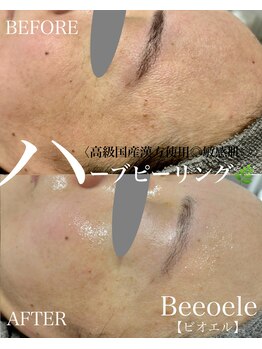 ビオエル(Bee'oele)/高級国産ハーブピーリング