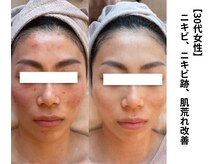 ボニータ(Bonita)/【Lit】ヒト羊膜幹細胞エステ