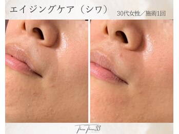 スリースリー 恵比寿(THREE THREE)/エイジングケア・しわ・たるみ