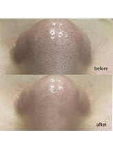 ダリアビューティー(Dahlia Beauty)/ハイドラBefore After