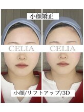 セリア(CELIA)/小顔矯正/小顔//面長/エラ張り