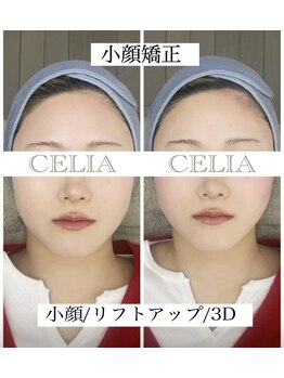セリア(CELIA)/小顔矯正/小顔//面長/エラ張り