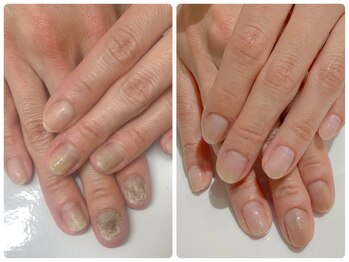 トイロ(toiro)/深爪がトラブルを引き起こす