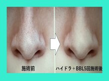 リュクス(LUXE)/施術前後　鼻回り