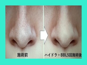 リュクス(LUXE)/施術前後　鼻回り