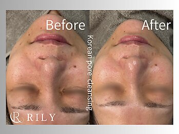 リリー(RILY)/【プラズマビフォーアフター】