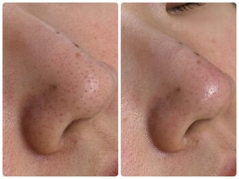 シェミー(CHEZ MEE)/冬にピッタリ♪乾燥・毛穴洗浄