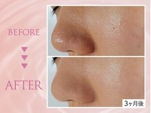 クリアラボ 池袋2nd(Clear Lab)/韓国肌管理&毛穴洗浄専門店