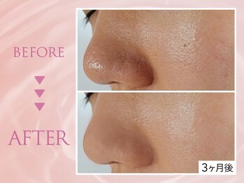 クリアラボ 池袋2nd(Clear Lab)/韓国肌管理&毛穴洗浄専門店