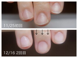 爪のお悩みのケア