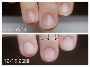 爪のお悩みのケア