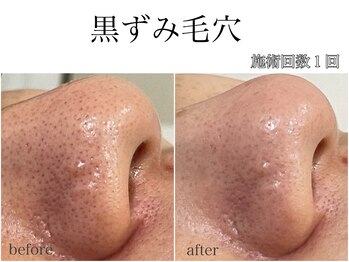 ラフェリ(Rafeli)/毛穴・黒ずみ・角栓悩み