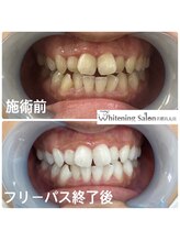 ホワイトニングサロン 京都烏丸店/ホワイトニング施術例